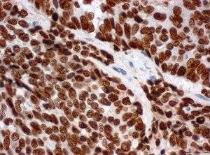 Tissue section of a cervical tumor. The cancer cells contain high levels of LEDGF protein (brown staining). © Miriam Reuschenbach, Heidelberg University Hospital 